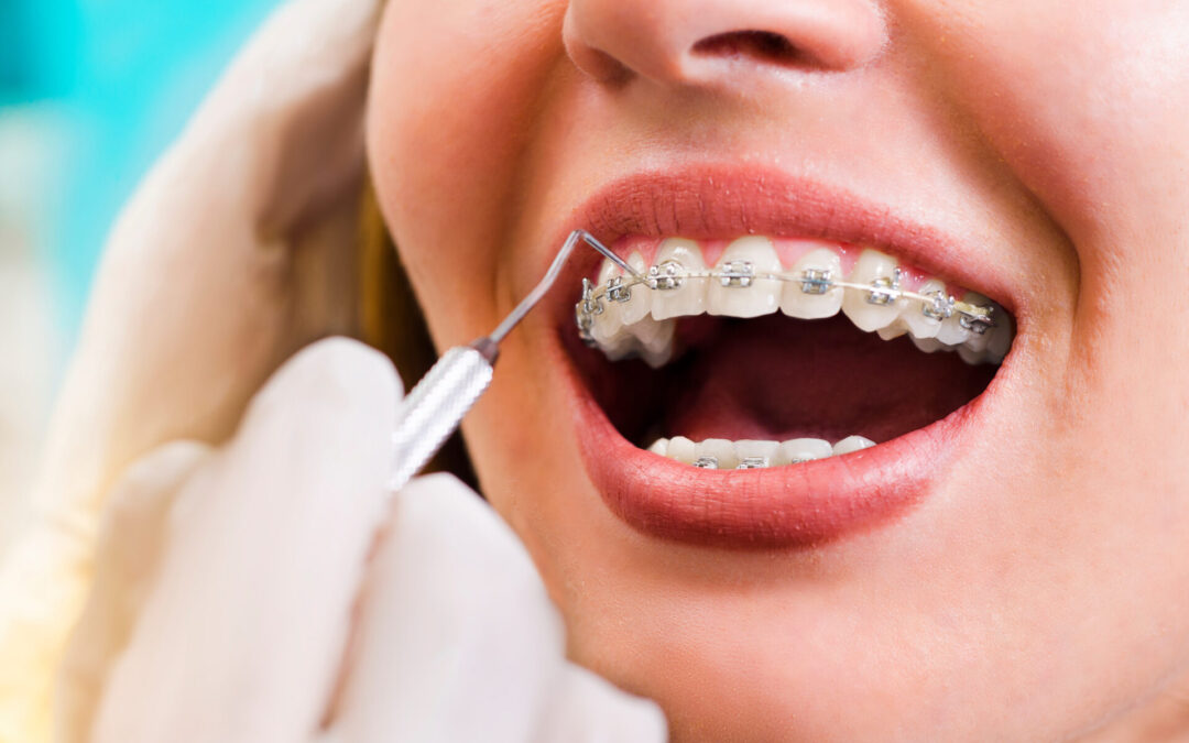 Closeup of young woman checking her braces - Orthodontist Redmond, WA